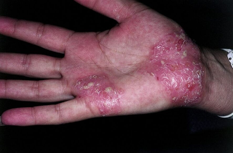 worsening of psoriasis on the hands