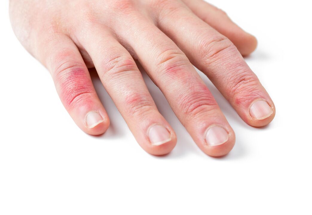 psoriasis in the child's hand