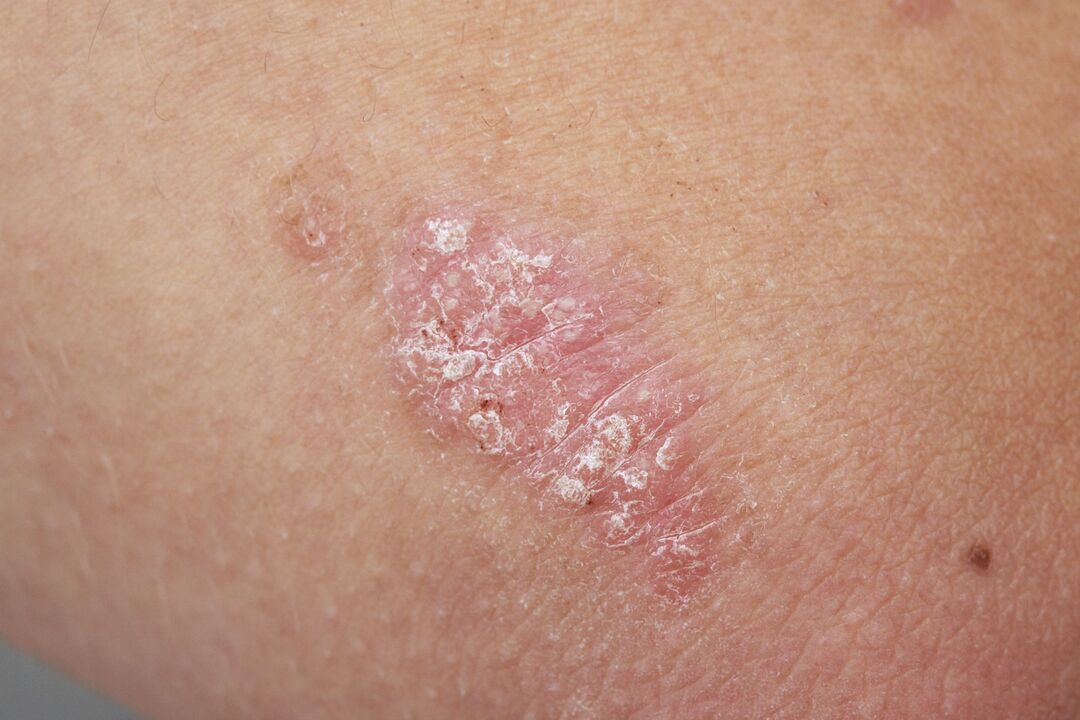 psoriasis on the child's skin