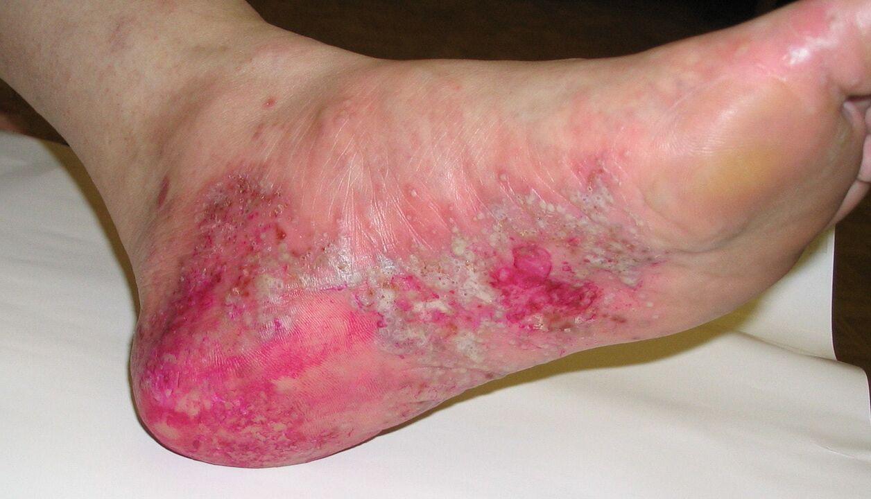 psoriasis on the leg