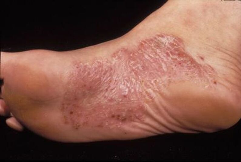 symptoms of psoriasis on the leg