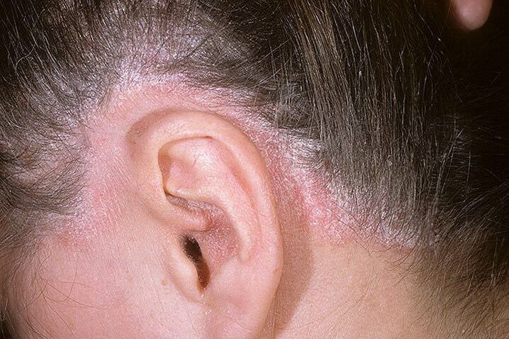 Psoriasis outbreaks on the head behind the ears