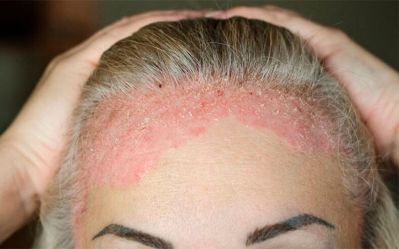 psoriasis on the scalp