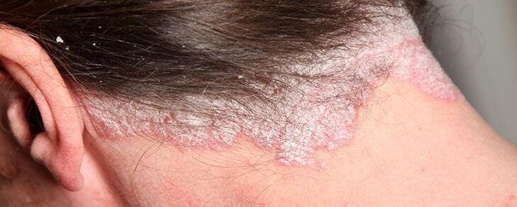 the stationary stage of psoriasis