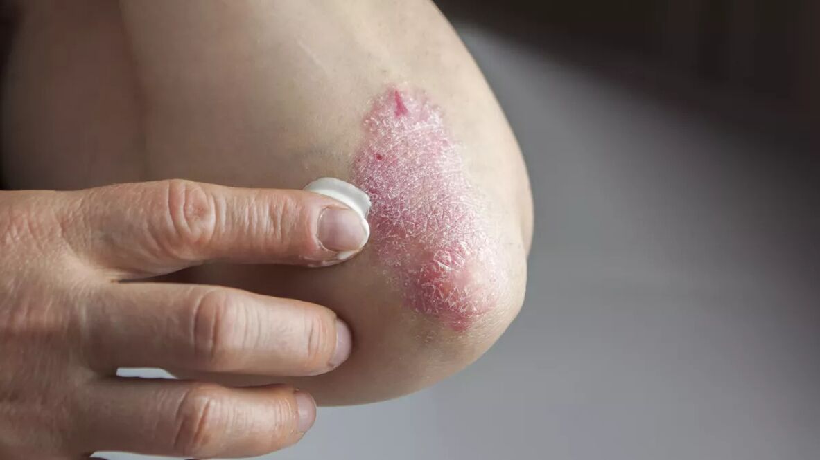 Psoriatic plaques on the elbows treated with medicated cream