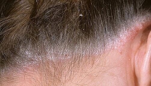 Psoriasis on his head