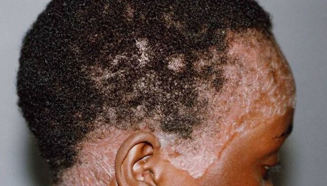 Psoriasis on his head