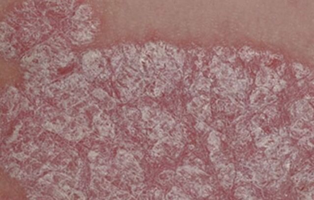 The healing of papules