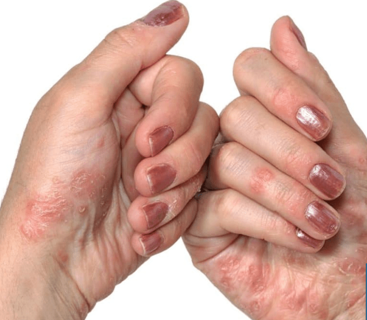 Psoriasis in the hands