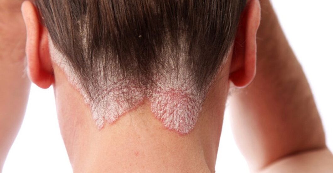 Psoriasis on the girls