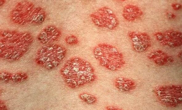 The forms of psoriasis