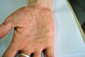 Psoriasis in his palm
