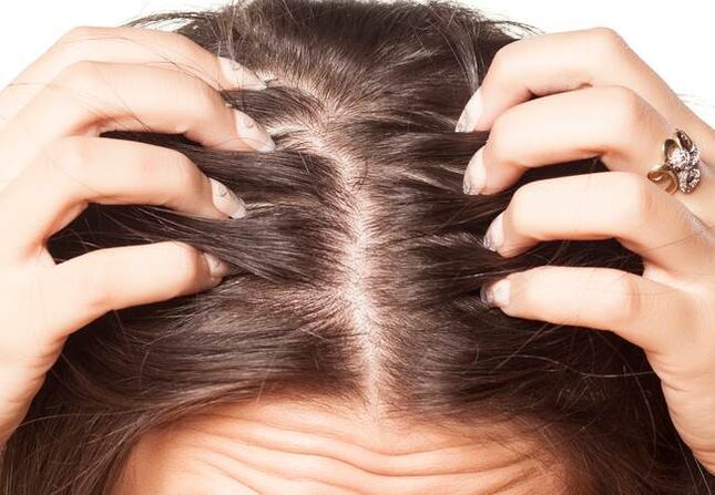 Psoriasis on his head