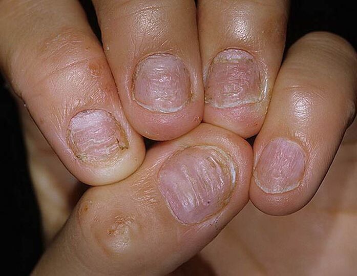 The nails are psoriasis