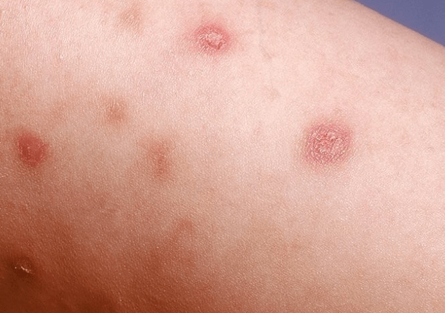 The initial stage of psoriasis