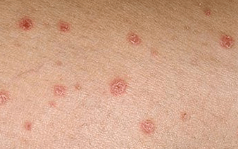 Psoriasis in the initial stage