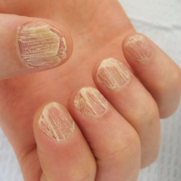 Nail damage caused by psoriasis
