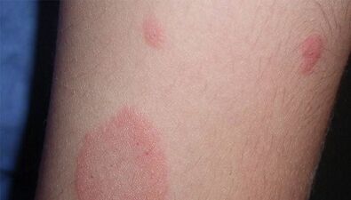 How does the initial stage of psoriasis manifest itself