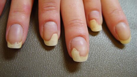 White spots on the nails due to psoriasis