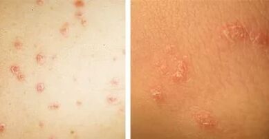 The main manifestations of psoriasis