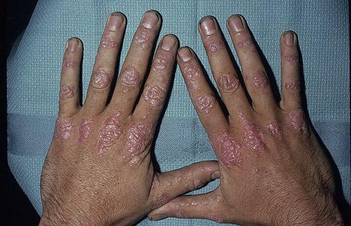 causes of psoriasis on the hands