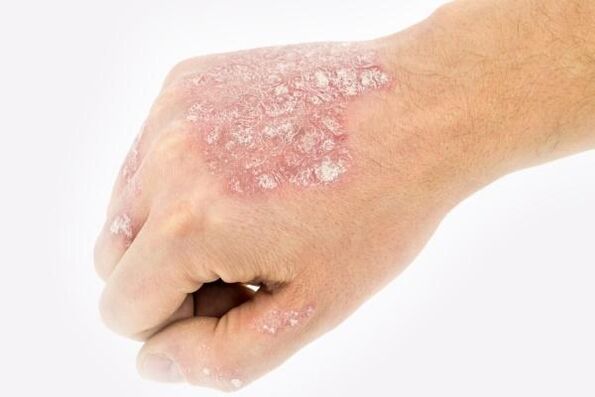 mechanism of psoriasis formation on the hands