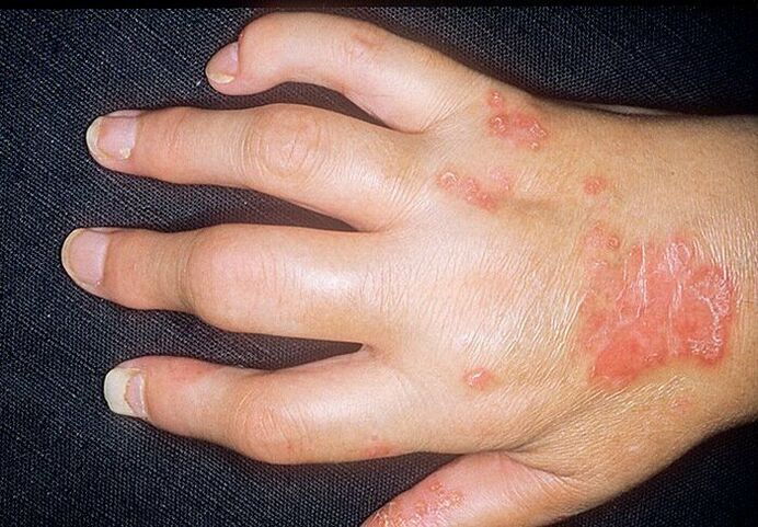 psoriasis arthritis of the hands