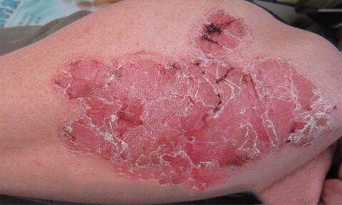 that looks like pustular psoriasis on the skin