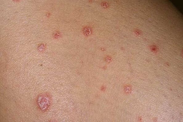 Small psoriasis outbreaks