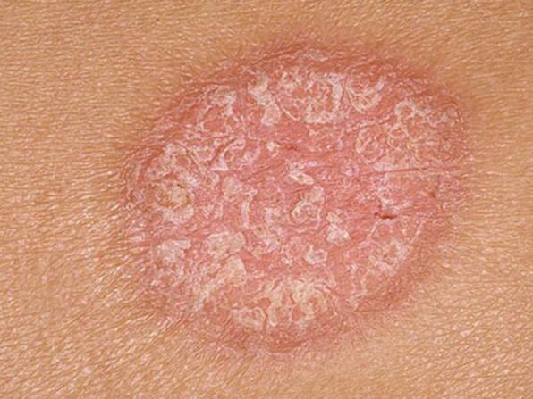 Standing section of papules