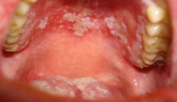 The mucosa is psoriasis
