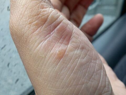photo psoriasis on the hands