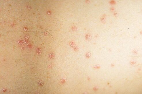 photo from the initial stage of psoriasis
