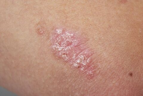 psoriasis plaque on the skin
