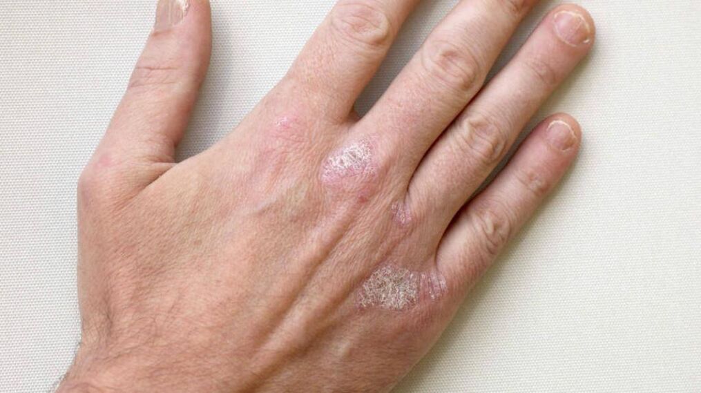 Psoriasis in the arm