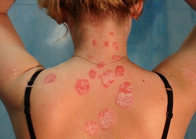 psoriasis of the neck s a htn