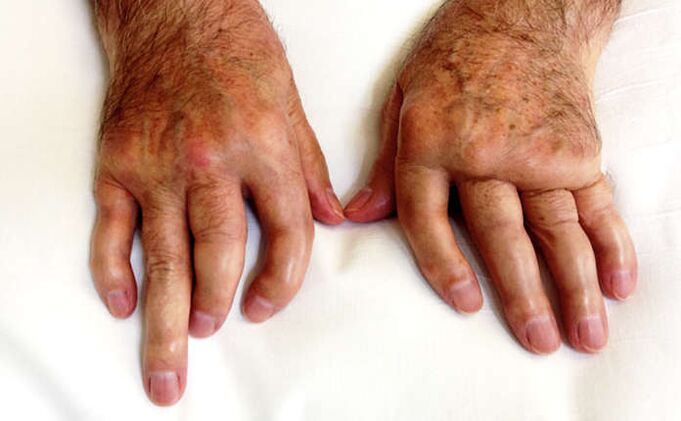 Arthritis in psoriasis