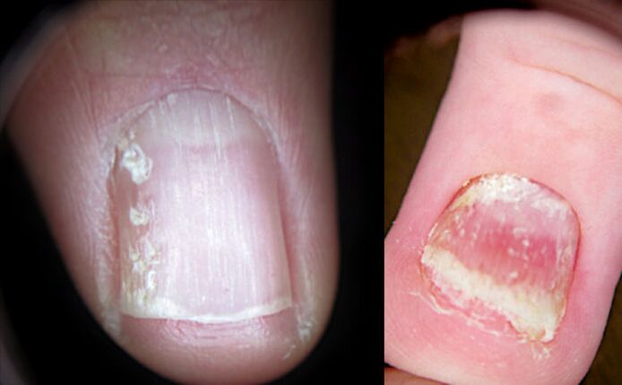 Crumbling nails in psoriasis