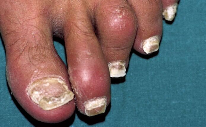 Psoriasis with nail involvement and arthritis of the toes (arthritis)