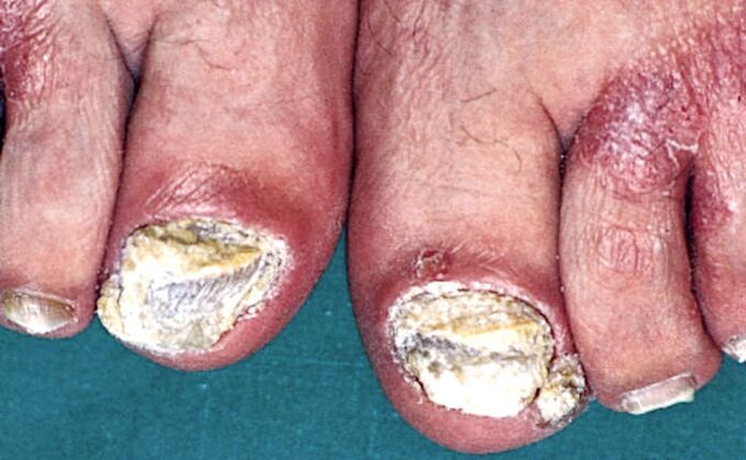 Severe subungual hyperkeratosis and psoriasis plaque on the toes