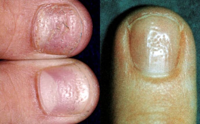 Symptom of throat - multiple depressions on the surface of the nail plate