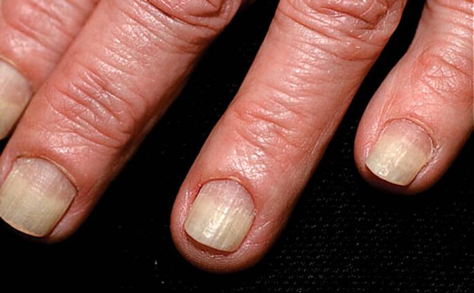 The spread of onycholysis from the edge of the nail to the nail fold