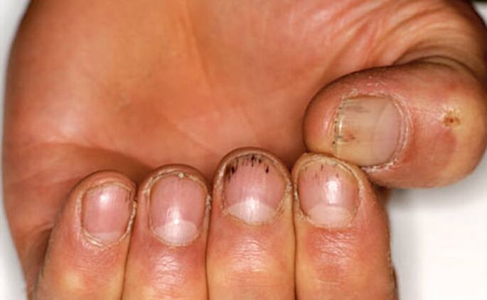 Vrzs under the nails with psoriasis