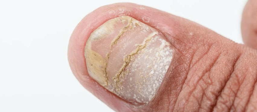 acute form of psoriasis complications on the nail