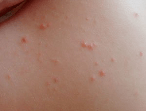 exact rash psoriasis symptom