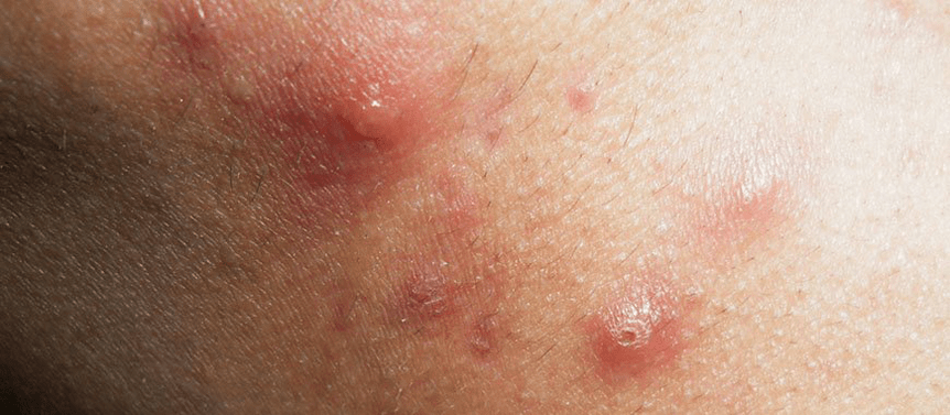 the onset of guttate psoriasis in childhood