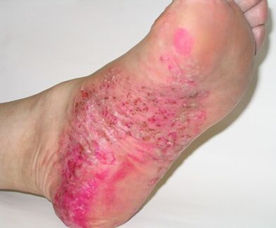 psoriasis on the leg